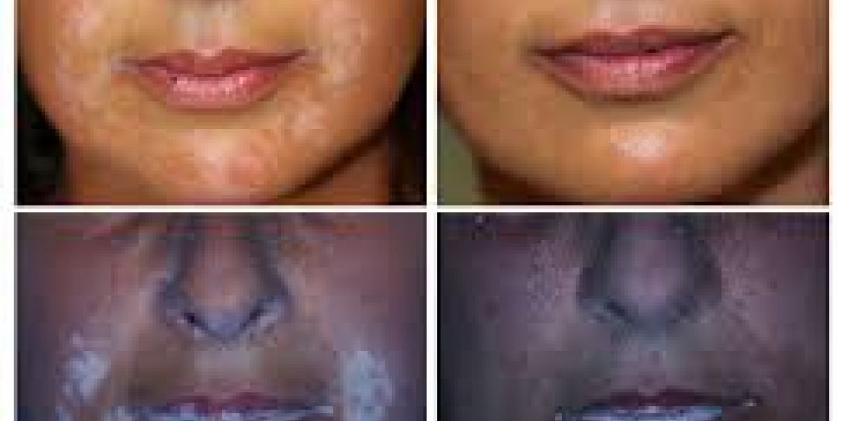 Révolution pour le Vitiligo