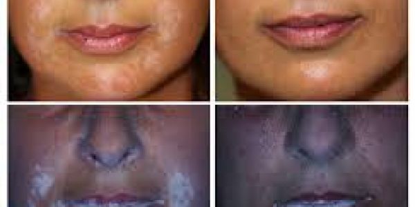 Révolution pour le Vitiligo